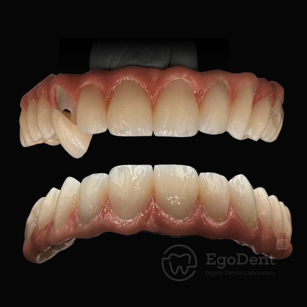 Anterior zirconia crowns and bridge, upper and lower arch