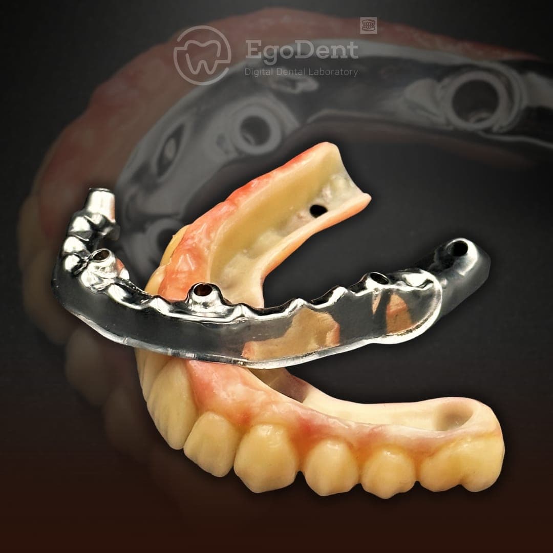 Full-arch screw-retained bridge seated over a titanium implant bar