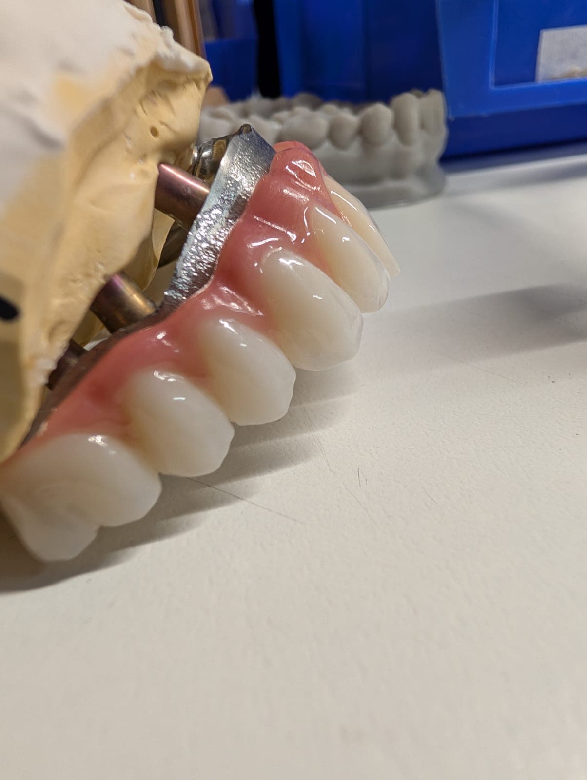 Screw-retained bridge on its working model with implant analogs